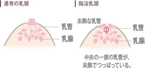 陥没乳首 男|陥没乳頭(陥没乳首) の治療・治し方等